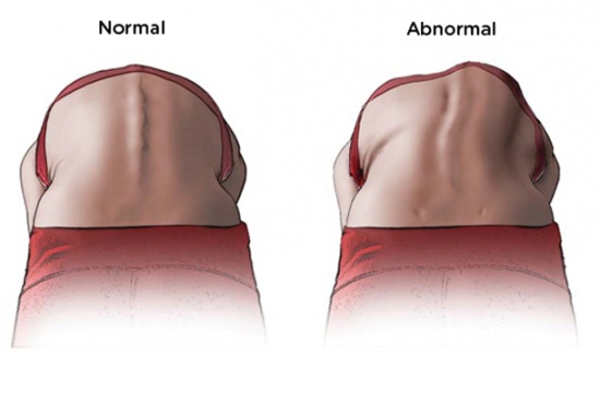 Osteopatia e Scoliosi