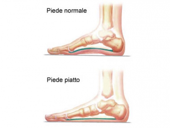 Piedi piatti?