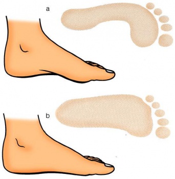 Piedi piatti?